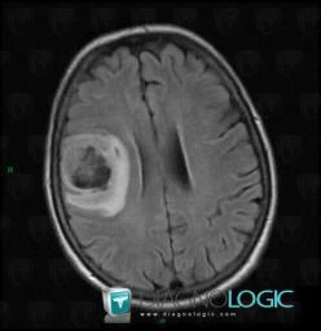 Glioblastoma multiforme, Cerebral hemispheres, MRI