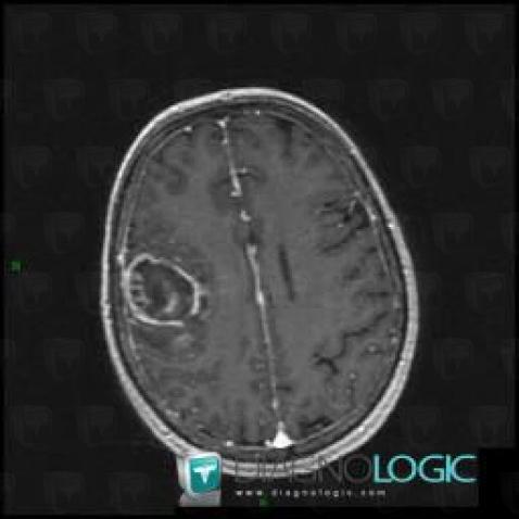 Glioblastoma multiforme, Cerebral hemispheres, MRI