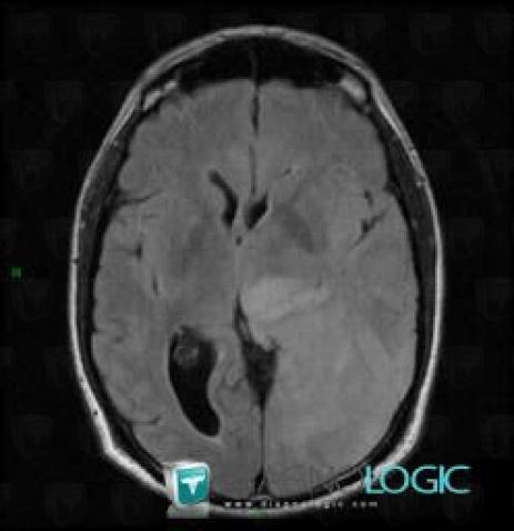 Glioblastoma multiforme, Cerebral hemispheres, MRI