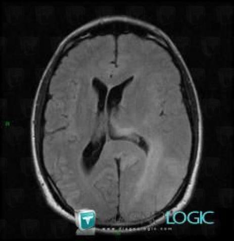 Glioblastoma multiforme, Cerebral hemispheres, MRI