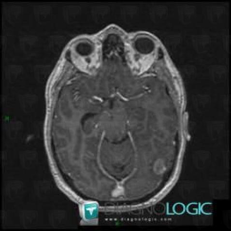 Glioblastoma multiforme, Cerebral hemispheres, MRI