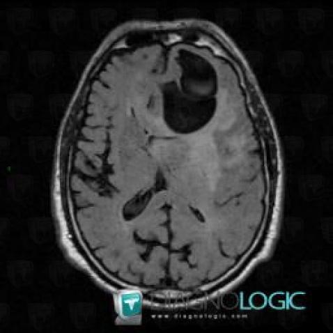 Glioblastoma multiforme, Cerebral hemispheres, MRI