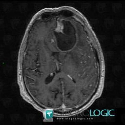 Glioblastoma multiforme, Cerebral hemispheres, MRI