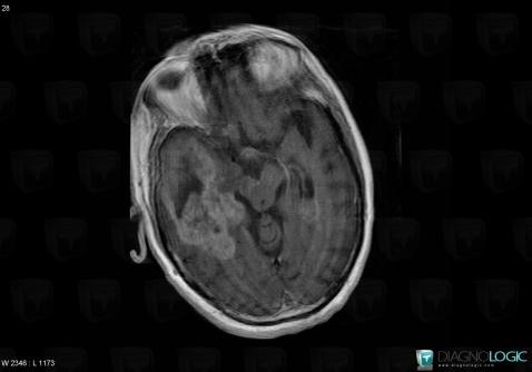 Glioblastoma multiforme, Cerebral hemispheres, MRI