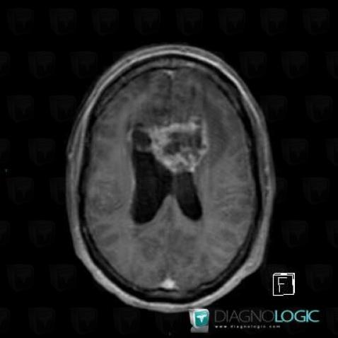 Glioblastoma multiforme, Cerebral hemispheres, MRI