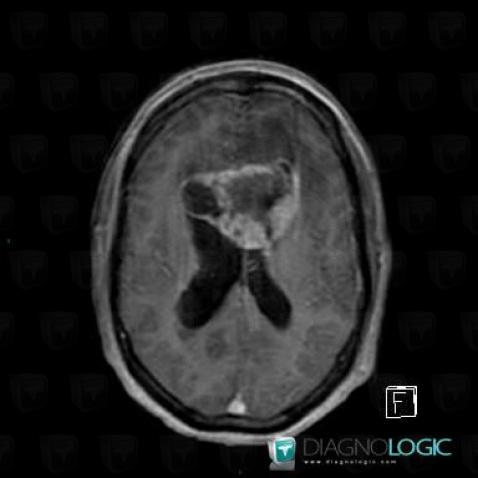 Glioblastoma multiforme, Cerebral hemispheres, MRI