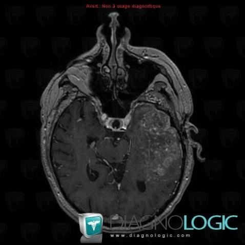 Glioblastoma multiforme, Cerebral hemispheres, MRI