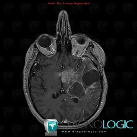 Glioblastoma multiforme, Cerebral hemispheres, MRI