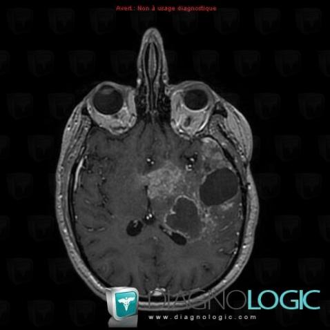 Glioblastoma multiforme, Cerebral hemispheres, MRI