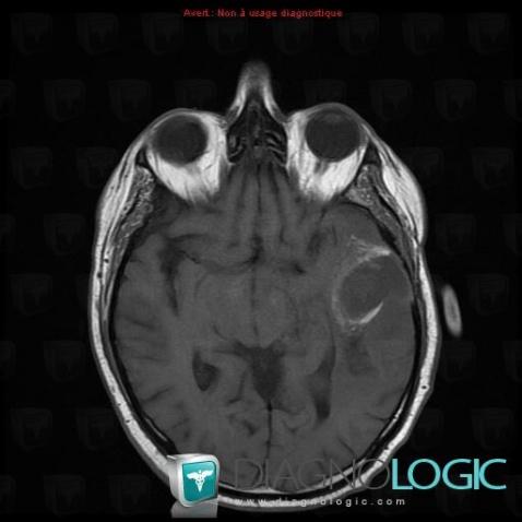 Glioblastoma multiforme, Cerebral hemispheres, MRI