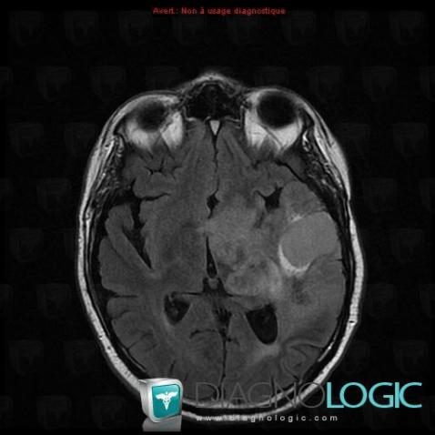 Glioblastoma multiforme, Cerebral hemispheres, MRI