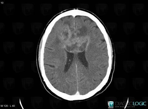 Glioblastoma multiforme, Corpus callosum, CT