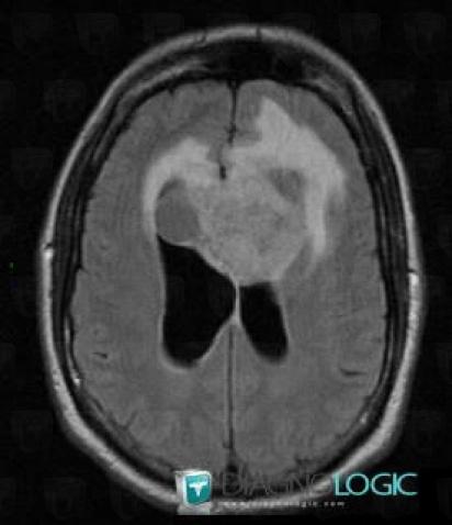 Glioblastoma multiforme, Corpus callosum, MRI