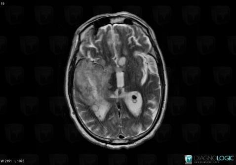 Glioblastoma multiforme, Cortico subcortical region, Cerebral hemispheres, MRI