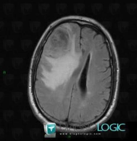 Glioblastoma multiforme, Cortico subcortical region, MRI