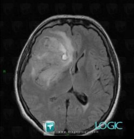 Glioblastoma multiforme, Cortico subcortical region, MRI