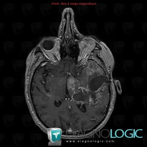 Glioblastoma multiforme, Cortico subcortical region, MRI