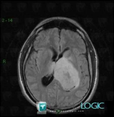 Glioblastoma multiforme, Ventricles / Periventricular region, MRI