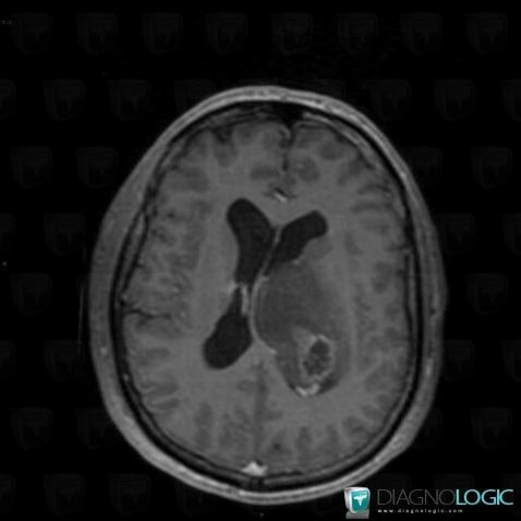 Glioblastoma multiforme, Ventricles / Periventricular region, MRI