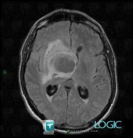 Glioblastoma multiforme, Ventricles / Periventricular region, MRI