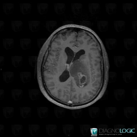 Glioblastoma multiforme, Ventricles / Periventricular region, MRI