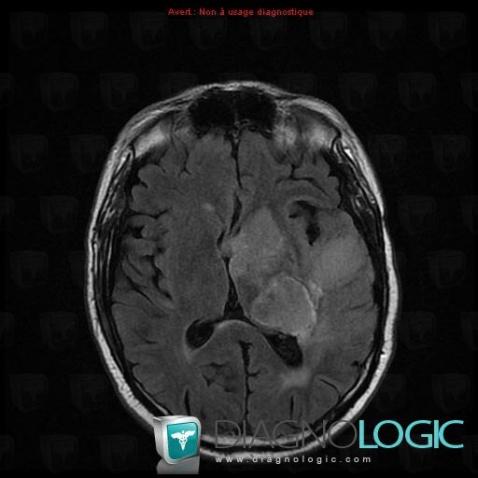 Glioblastoma multiforme, Ventricles / Periventricular region, MRI