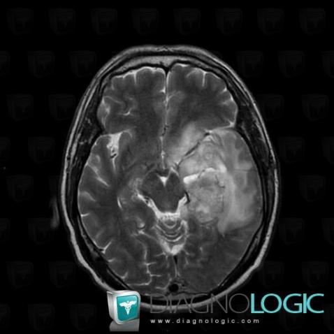 glioblastome irm diagnologic dessus spcifiques cl ci