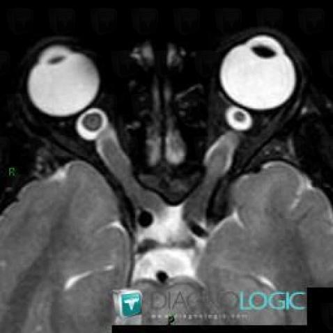 Gliome-nerf optique , Nerf optique, OEil, IRM