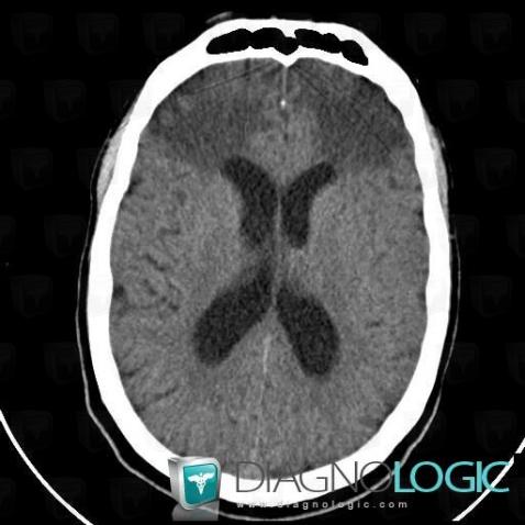 Gliosis, Cerebral hemispheres, CT