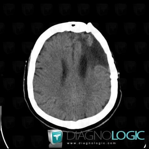 Gliosis, Cerebral hemispheres, CT