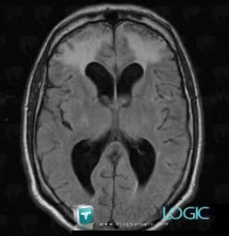 Gliosis, Cerebral hemispheres, MRI