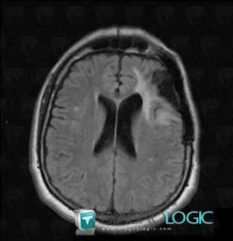 Gliosis, Cerebral hemispheres, MRI