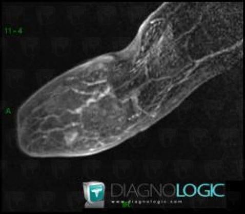 Glomus tumor, Other soft tissues/nerves - Hand, MRI