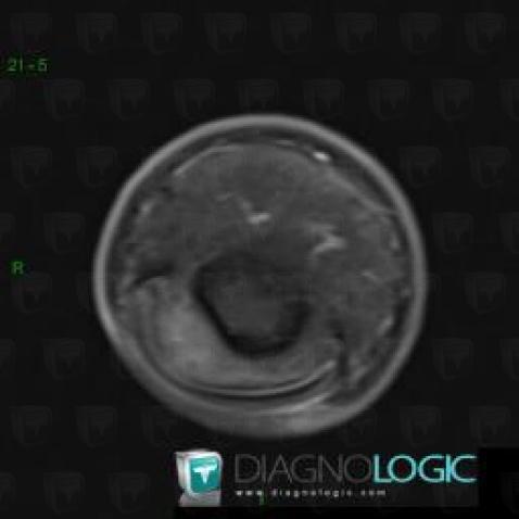 Glomus tumor, Other soft tissues/nerves - Hand, MRI