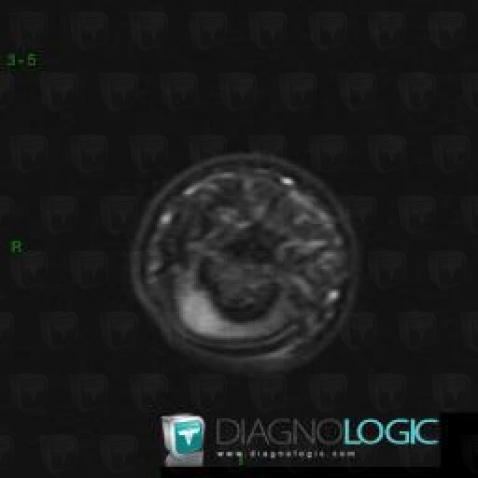 Glomus tumor, Phalanx / Sesamoid bones - Hand, Other soft tissues/nerves - Hand, MRI