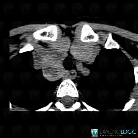 Goiter, Mediastinum, CT