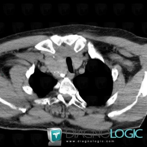Goiter, Mediastinum, CT