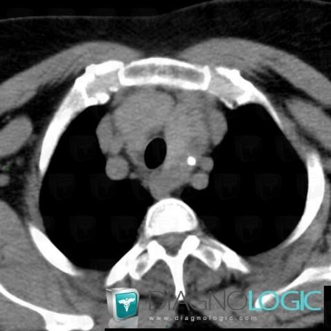 Goiter, Mediastinum, CT