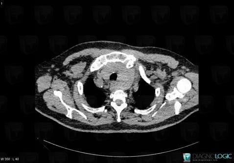 Goiter, Mediastinum, CT