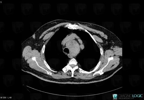 Goiter, Mediastinum, CT