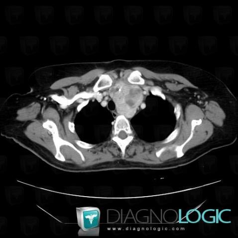 Goiter, Mediastinum, CT