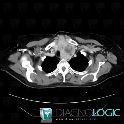 Goiter, Mediastinum, CT