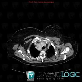 Goiter, Mediastinum, CT