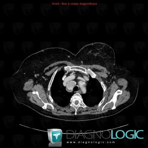 Goiter, Mediastinum, CT