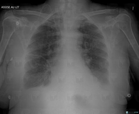 Goiter, Mediastinum, X rays