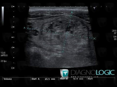 Goitre multinodulaire, Thyroïde/ Parathyroïde, Echographie
