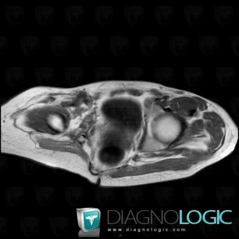 Gorham’s disease, Femur - Proximal part, MRI