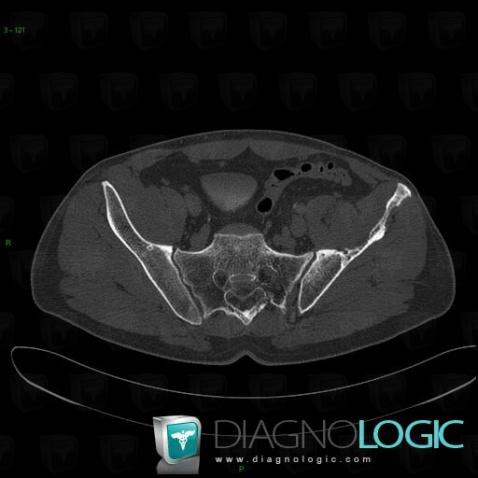 Gorham’s disease, Ilium, CT