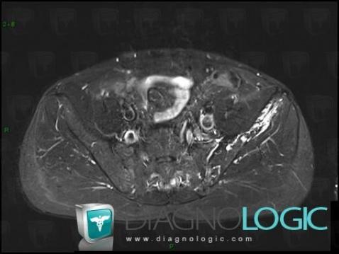 Gorham’s disease, Ilium, MRI