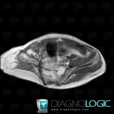 Gorham’s disease, Ilium, MRI